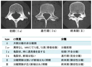 腰椎分離症