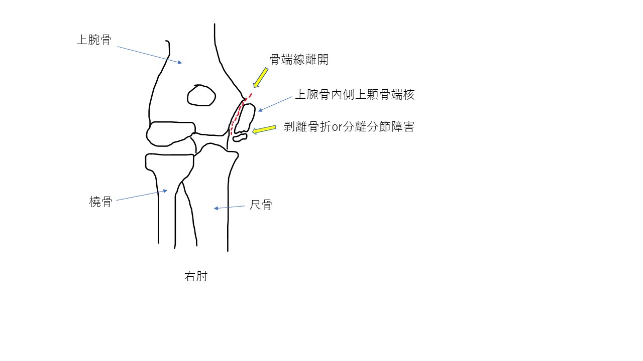 野球肘