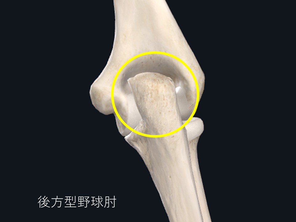 後方型野球肘