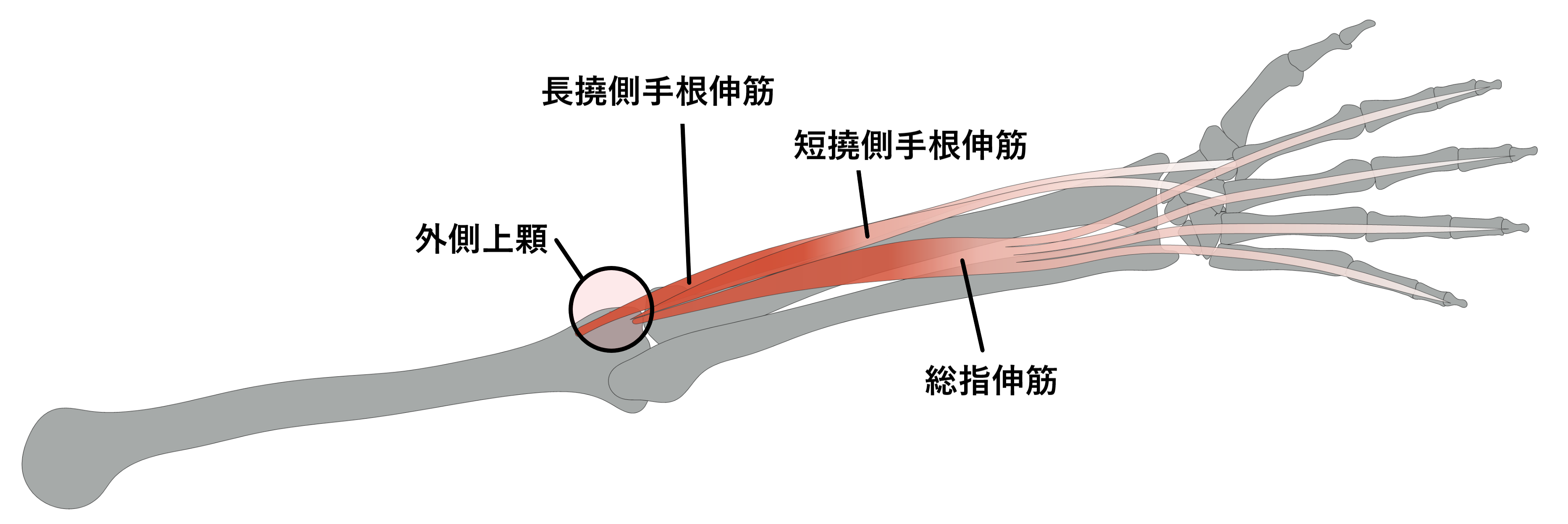 テニス肘