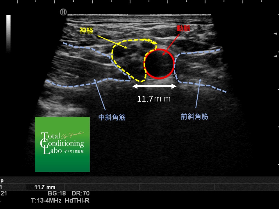 胸郭出口症候群エコーISD