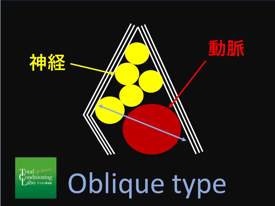 胸郭出口症候群　TOS