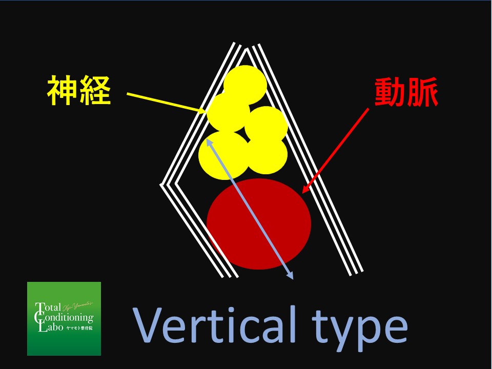 TOS　胸郭出口症候群