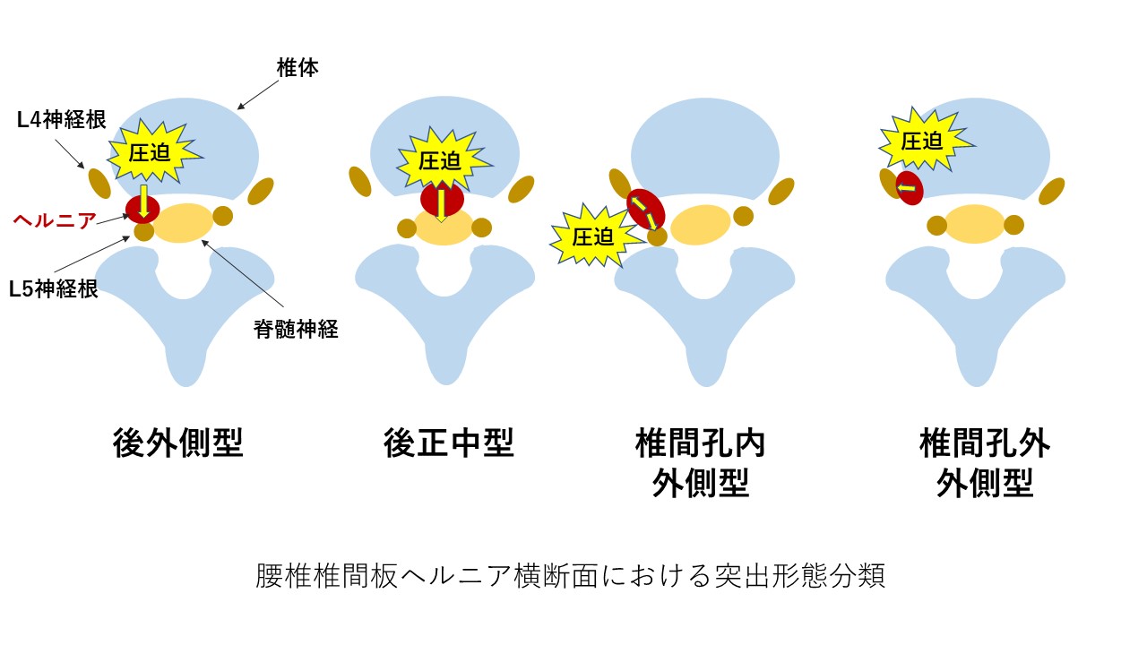 椎間板ヘルニア