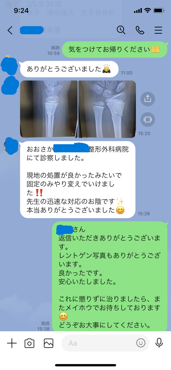 コーレス骨折