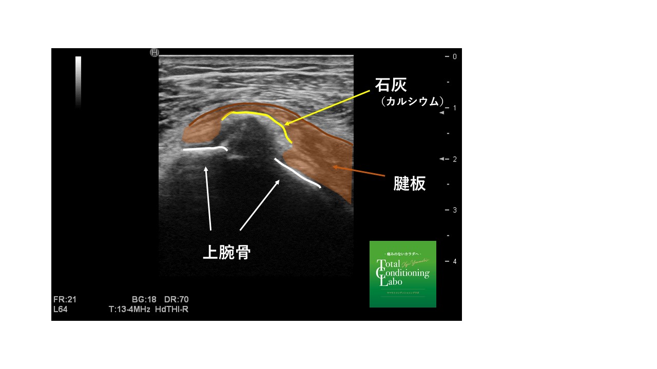 石灰沈着性腱板炎